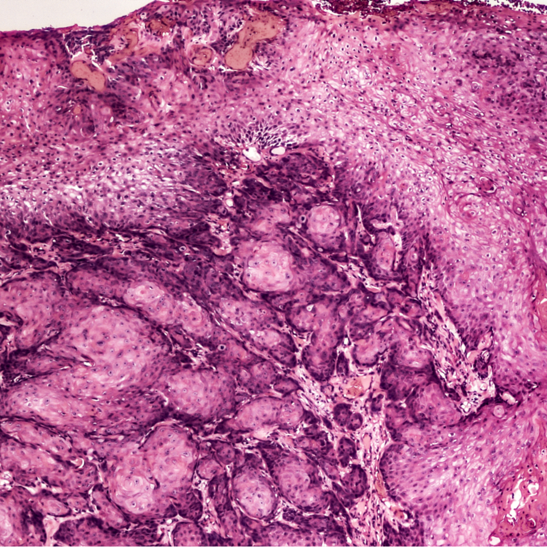 Effective combinatorial immunotherapy for penile squamous cell carcinoma